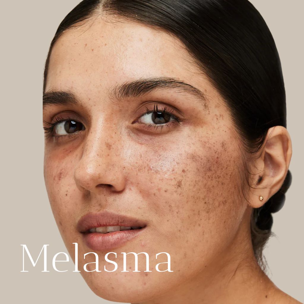 Melasma