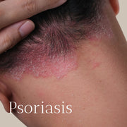 Psoriasis