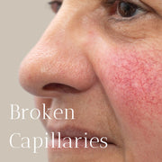 Broken Capillaries