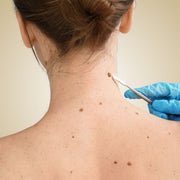 Fjerning av hudtagger (skin tags)