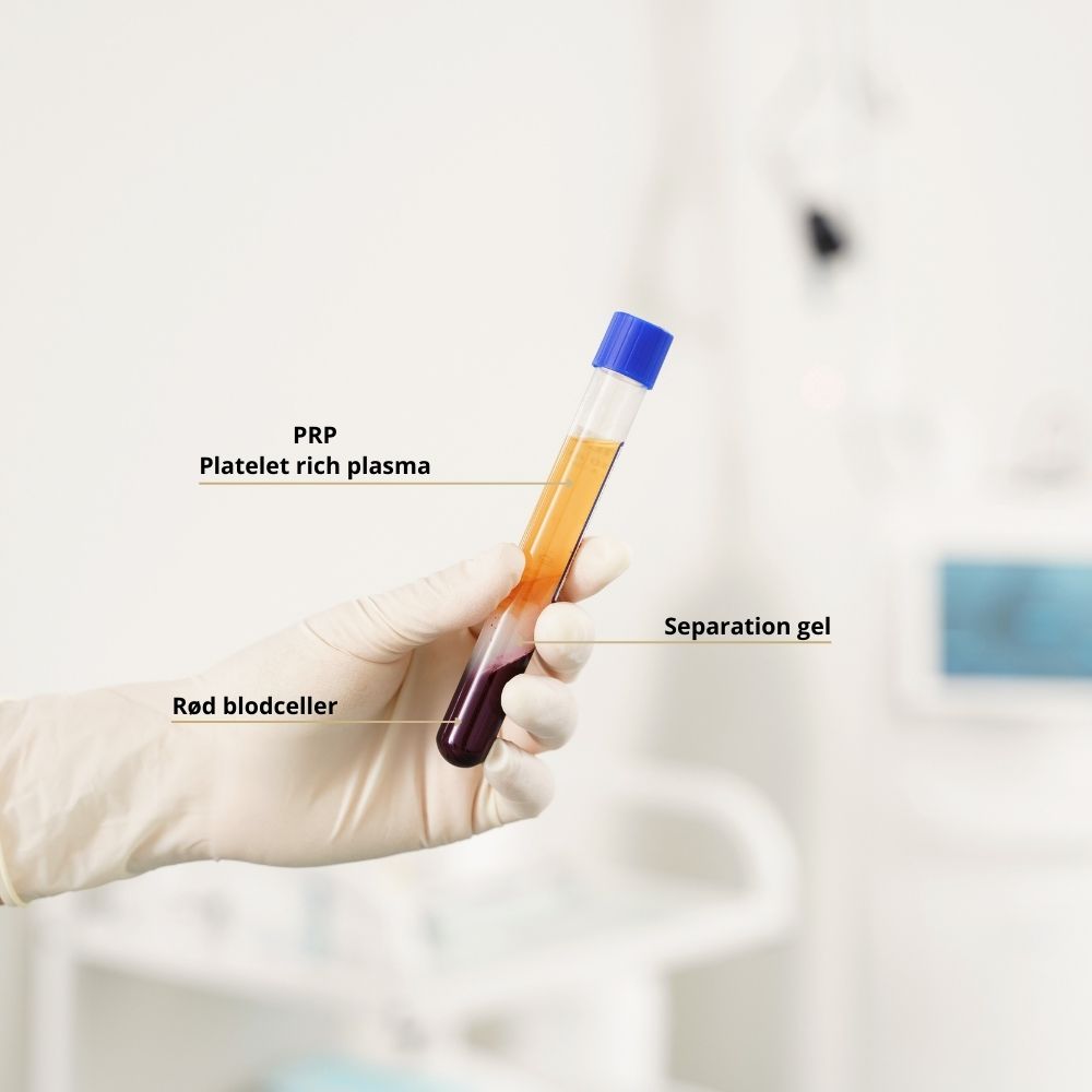 PRP Hår - Platelet rich plasma