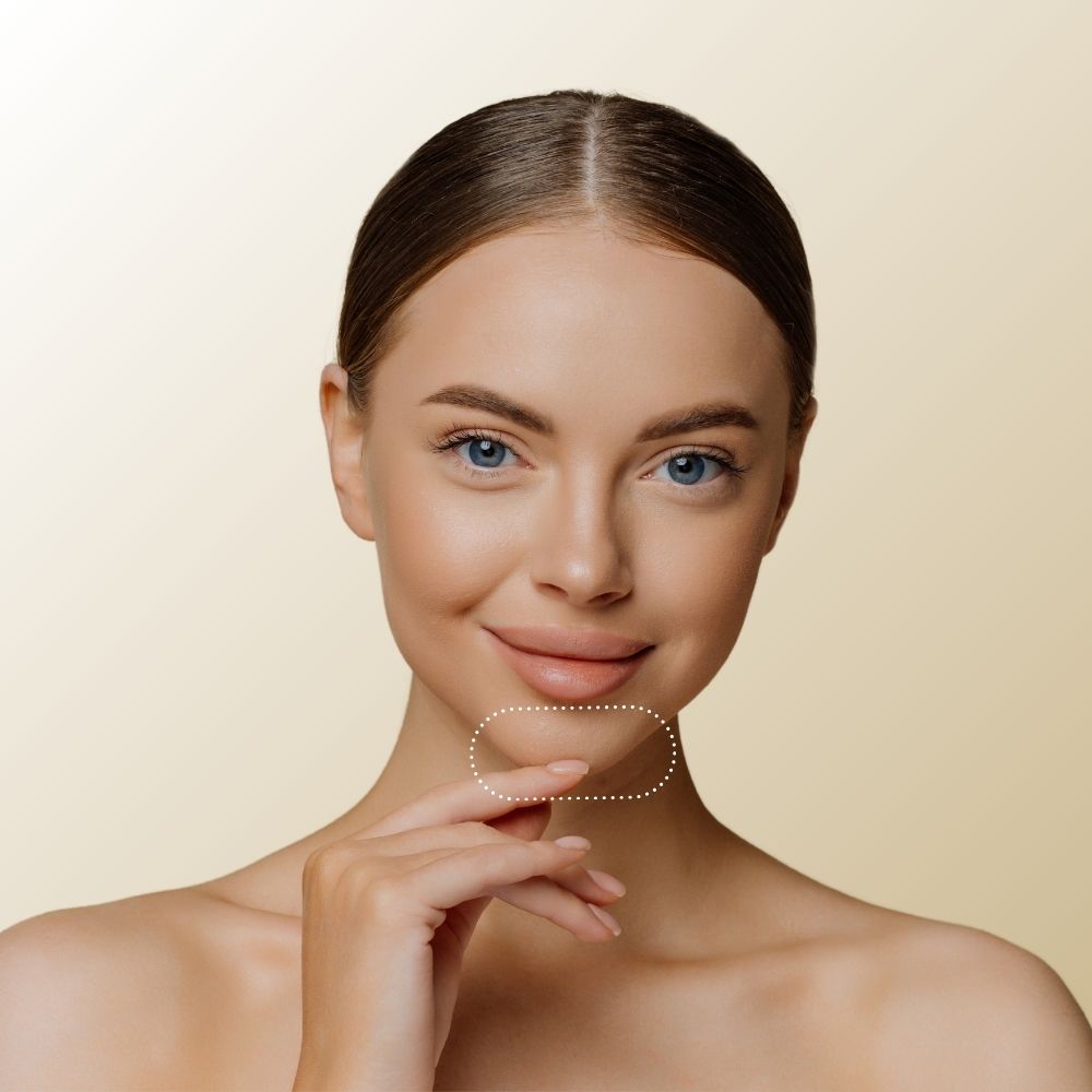 Restylane® Chin Filler