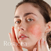 Rosacea